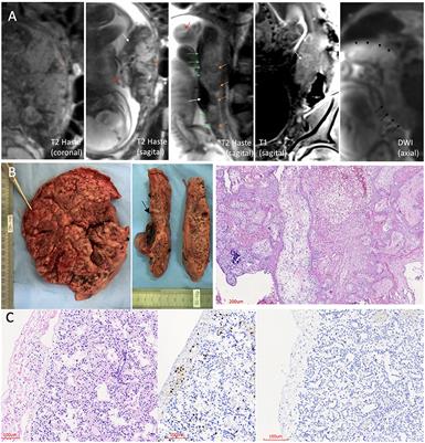 Case Report: SARS-CoV-2 Mother-to-Child Transmission and Fetal Death Associated With Severe Placental Thromboembolism